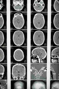 Traumatic Brain Injury Lawyer North carolina